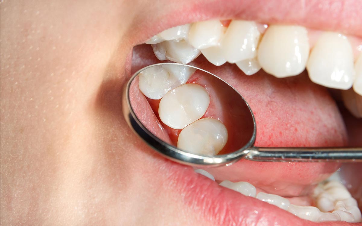 Foto von reparierten Zähnen - Füllungstherapie