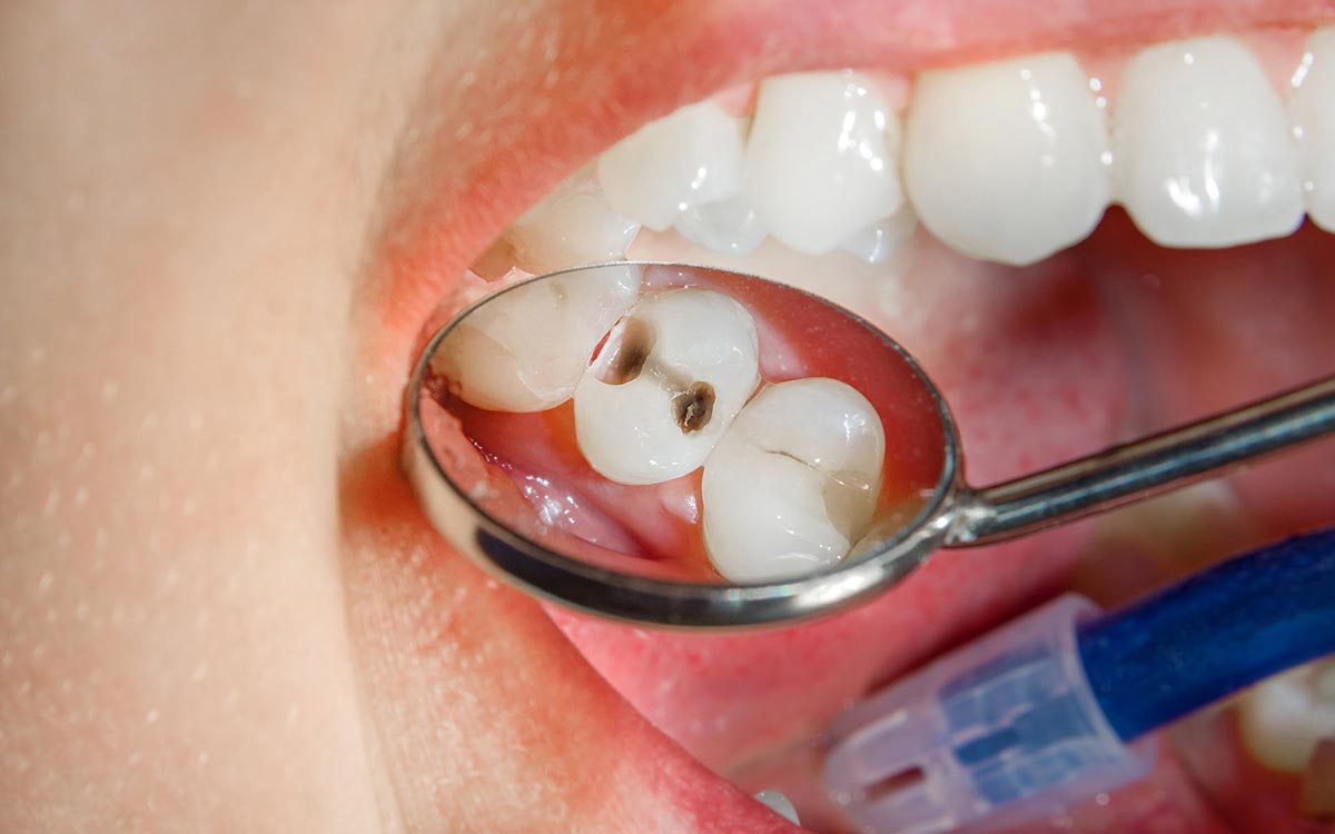 Foto von Zähnen mit Karies - Füllungstherapie