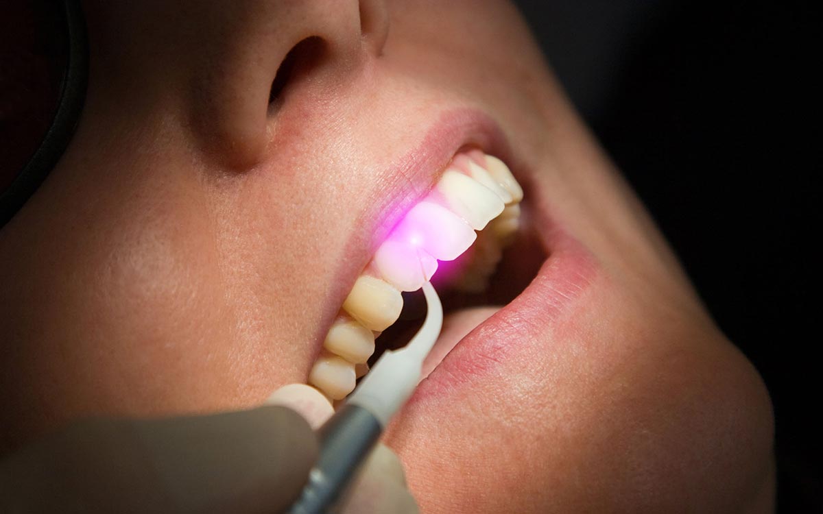 Foto zeigt offenen Mund bei einer Laserbehandlung