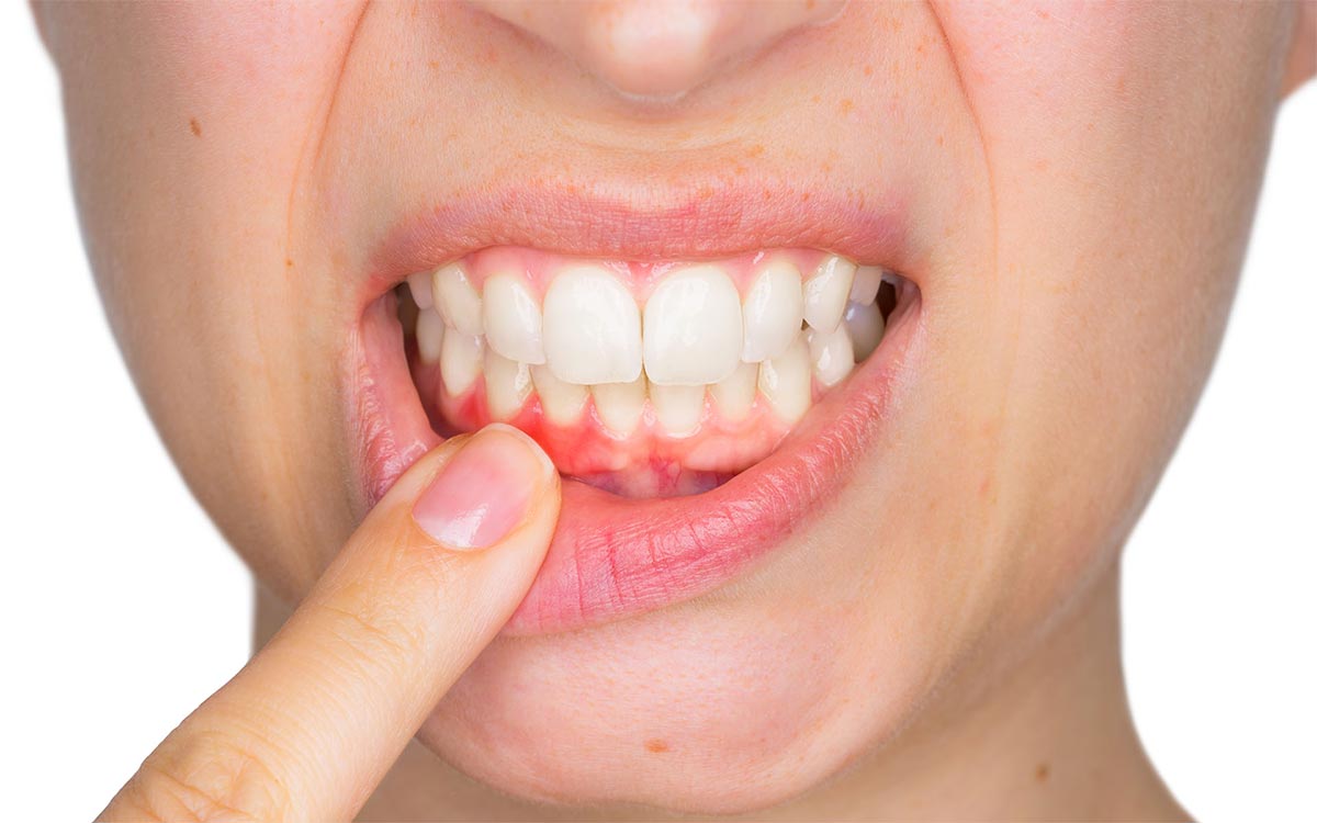 Foto zeigt offenen Mund mit Zahnfleischerkrankung